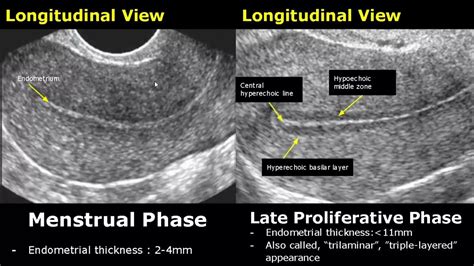 endometrial thickness ultrasound